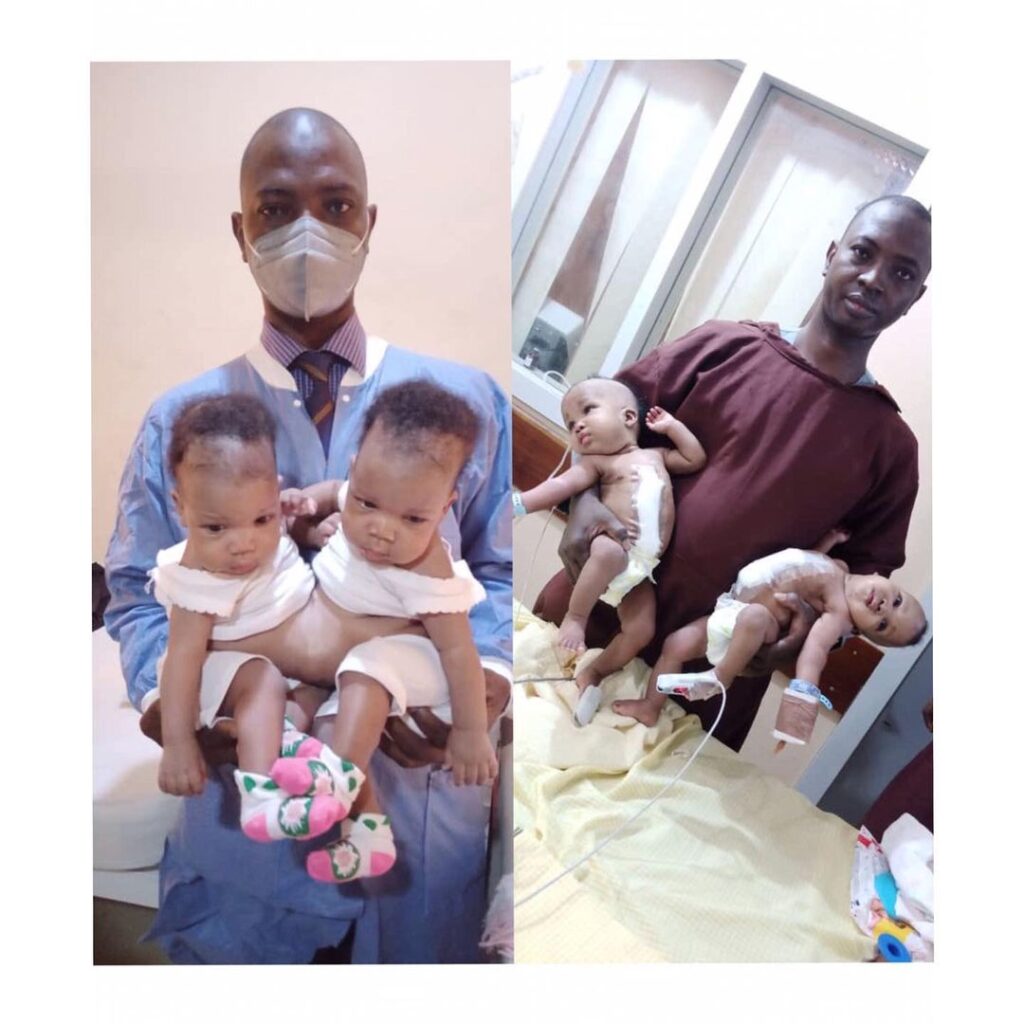 Doctors successfully separate conjoined twins in Kwara