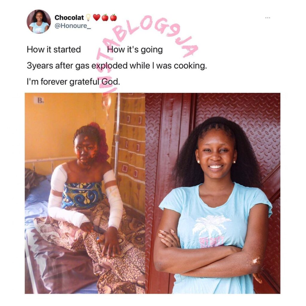 Nigerian chef shares her transformation three years after falling victim of cooking gas explosion