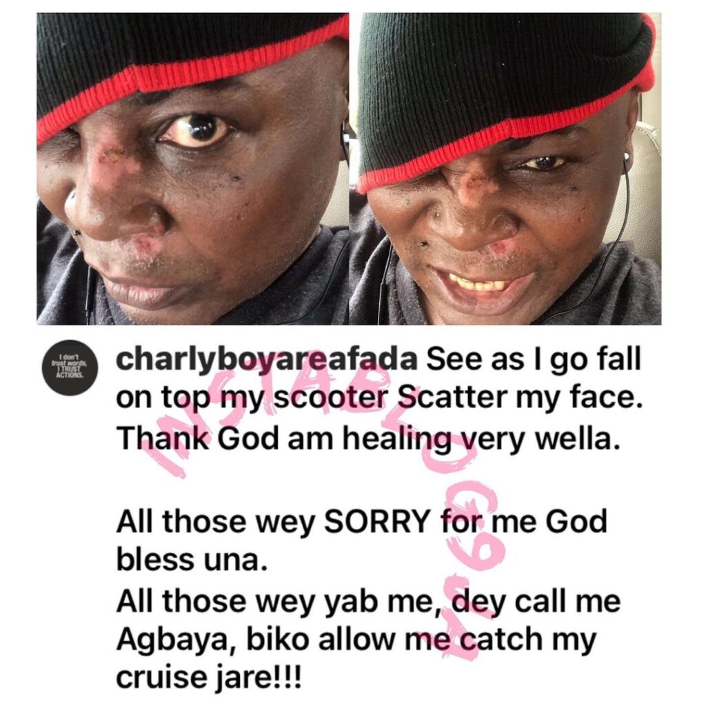 Singer CharlyBoy’s face peeled after a ghastly scooter accident