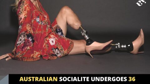 Australian socialite undergoes 36 surgeries and has both feet amputated after mosquito bite in Nigeria . .